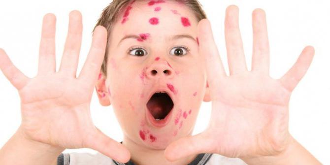 子供の水痘。病気の症状。この期間にどのように行動するのですか？